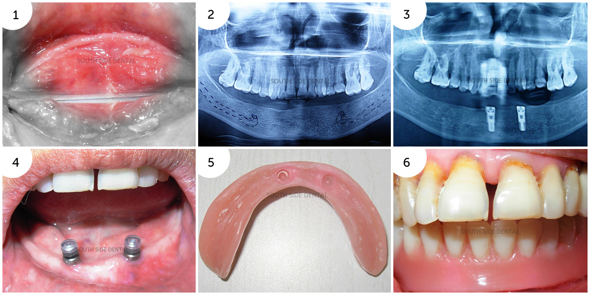 Implant over Denture